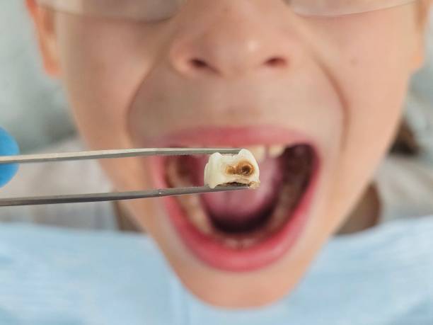 Best Root Canal Emergency Dentist  in Parowan, UT